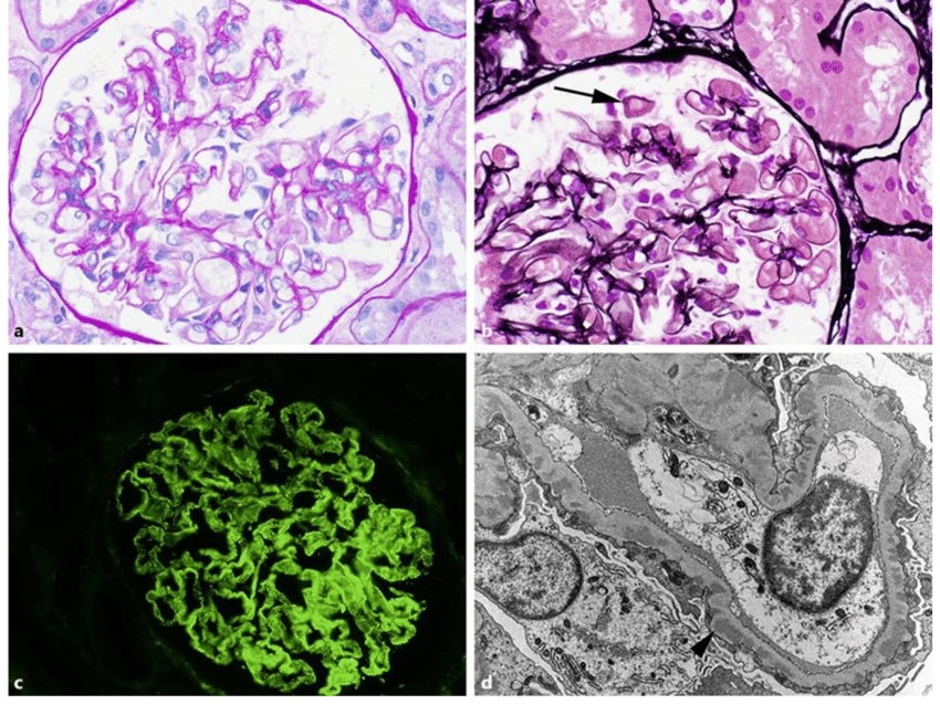 What Is the Best Focal Segmental Glomerulosclerosis Diet, and What Causes FSGS Kidney Disease?