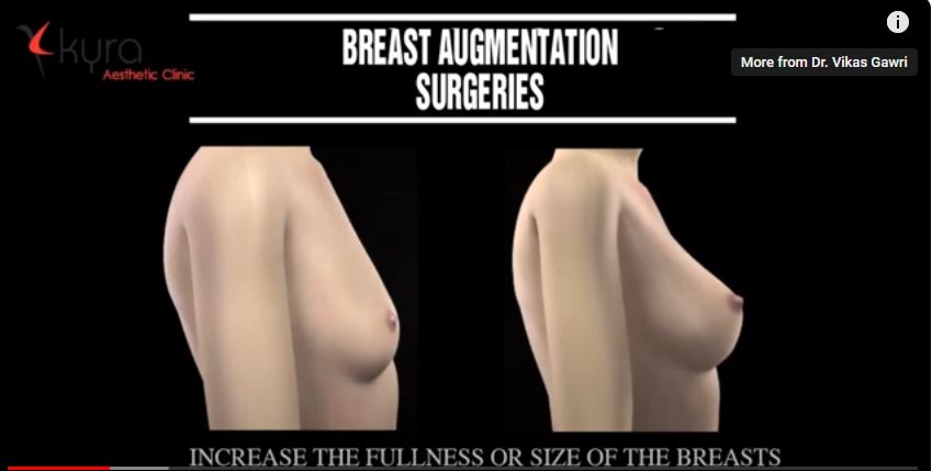 Breast Augmentation Cost in Ludhiana