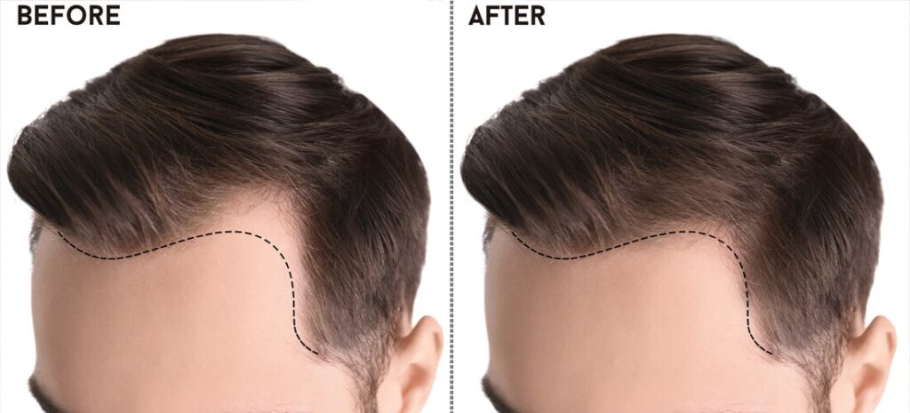 Choosing Excellence: A Comprehensive Guide to the Best Hair Transplant in Islamabad