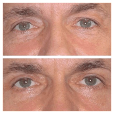 Eye Bag Removal Options Discussed by the Best Doctors in Dubai