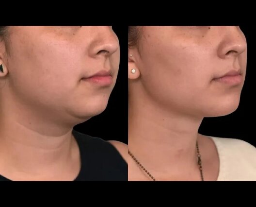 Double Chin Removal for All Ages: Insights from the Best Doctors in Dubai