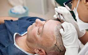 Hair Transplant Clinic in Pune: A Complete Guide to Restoring Your Hair and Confidence