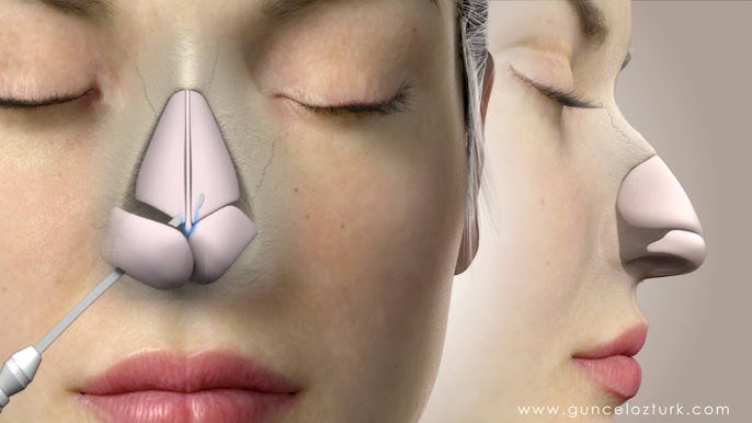 Rhinoplasty Dubai: The Ultimate Guide to Achieving Your Perfect Nose