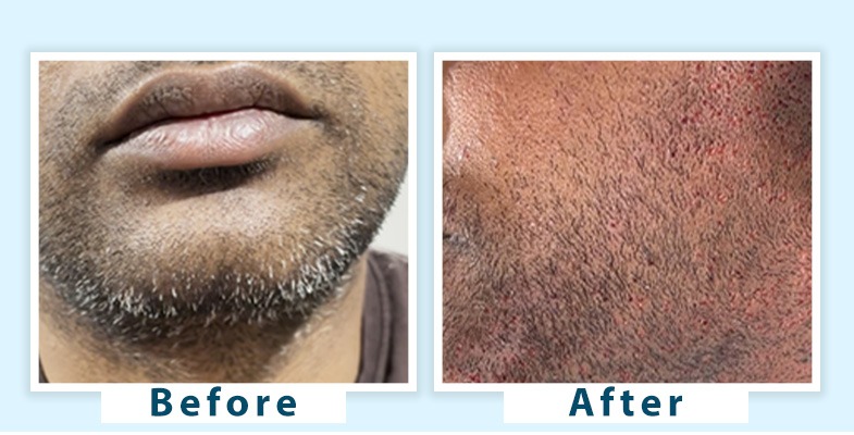 Best Grey Beard Treatment Options to Restore Your Natural Look