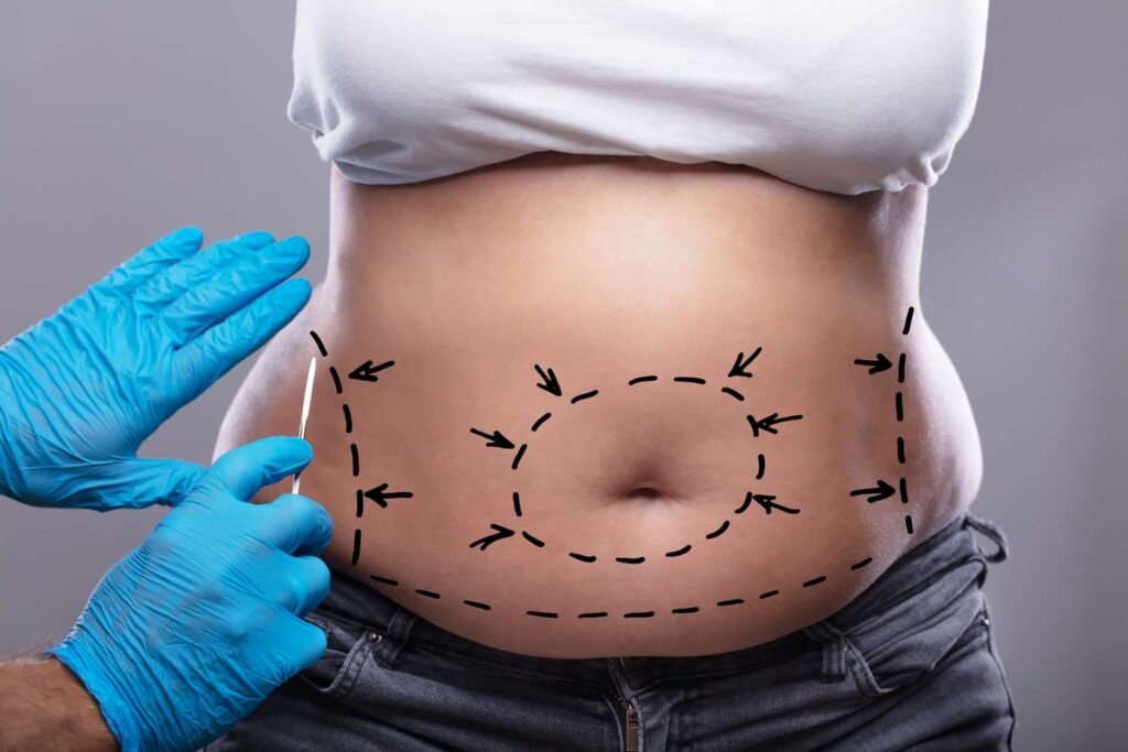 How to Evaluate the Best Tummy Tuck Surgeons in Dubai: A Step-by-Step Guide