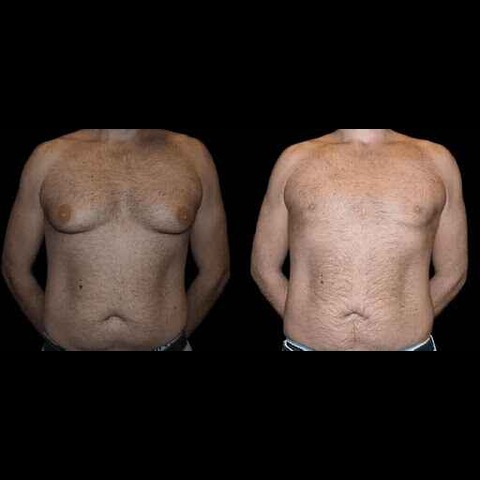 Best Gynecomastia Surgeons in Dubai: What Makes Them Stand Out