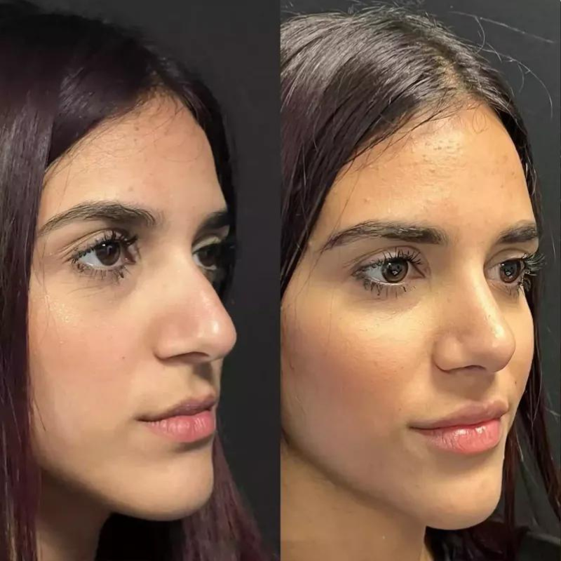 Best Rhinoplasty Surgeons in Dubai: Where Expertise Meets Aesthetic Precision