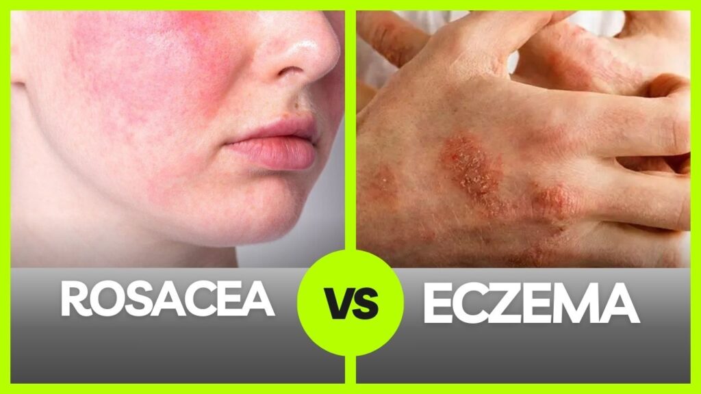 Eczema vs Rosacea on Face: Symptoms, Causes, and Treatment